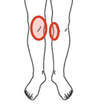 膝の痛みの場所を示す図