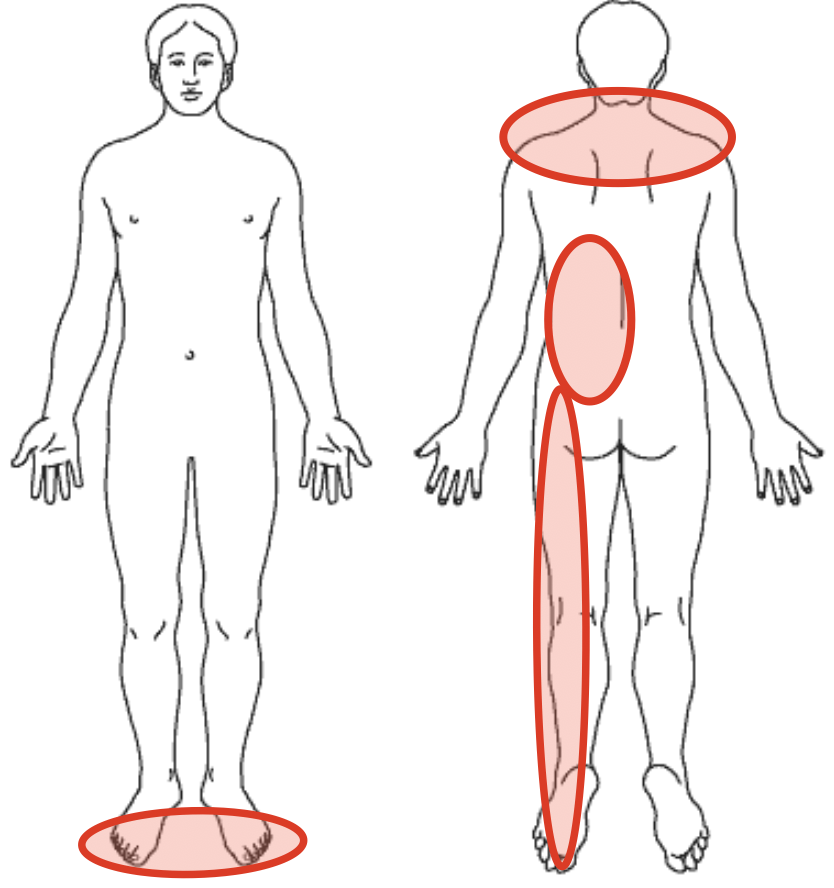 肩こり、左腰の痛み、左脚の痛み、しびれを示す図