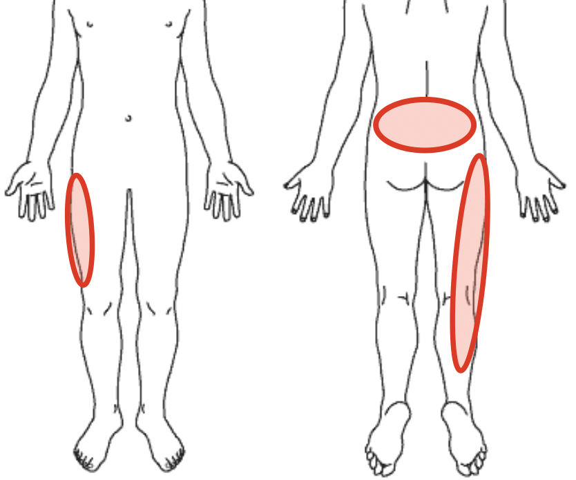 腰痛、右太もも、右ふくらはぎの痛みを示す図
