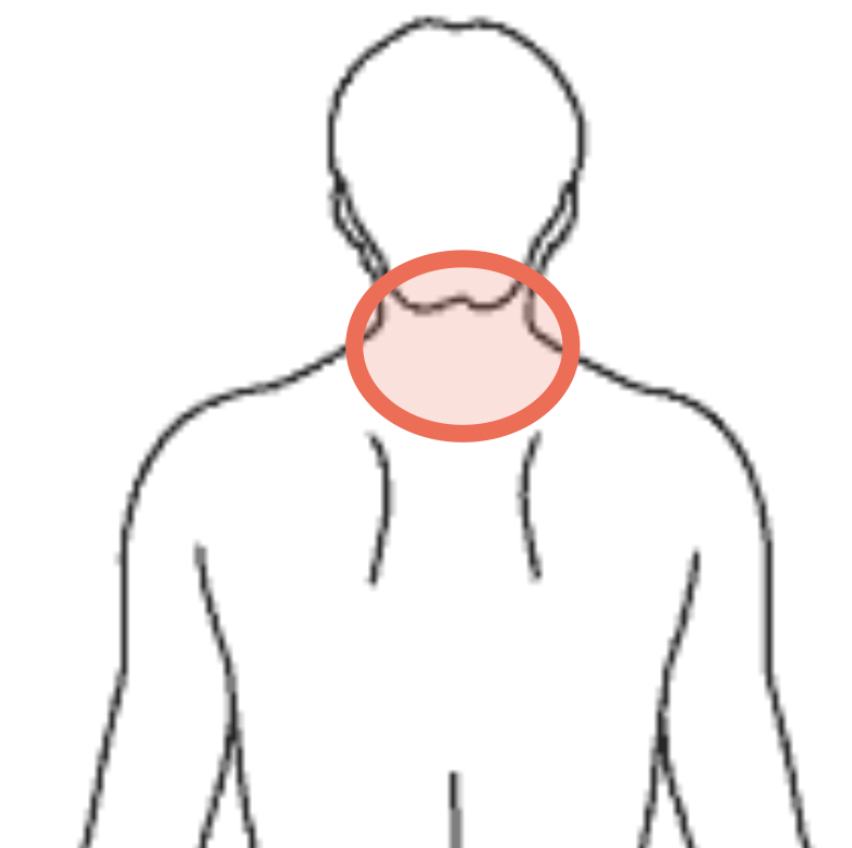 腰と股関節の痛みの場所を示す図