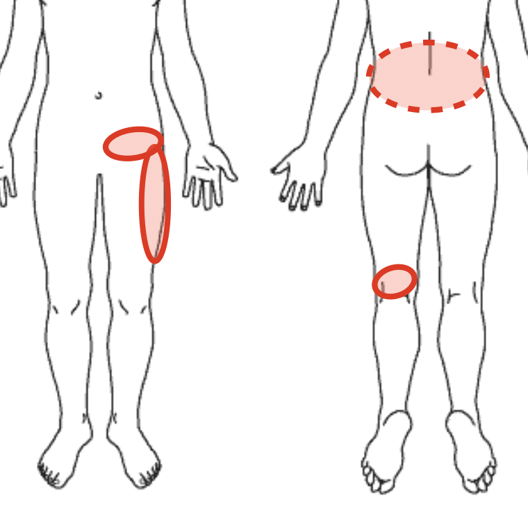腰と股関節の痛みの場所を示す図