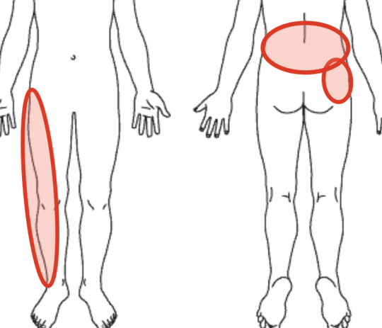 腰の痛みの場所を示す図