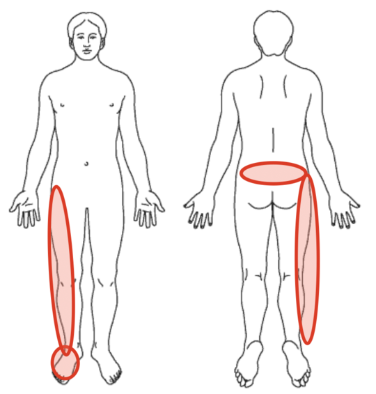 肩こり、左腰の痛み、左脚の痛み、しびれを示す図