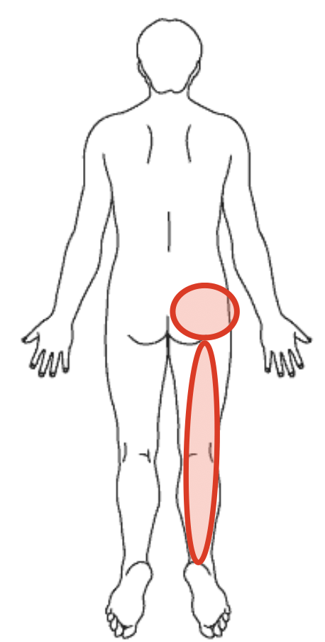 右殿部痛の図